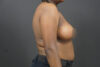 Breast Lift case #4682