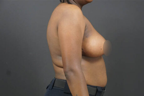 Breast Lift case #4682