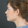 Chin Liposuction case #4829