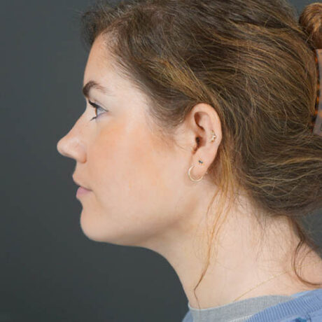 Chin Liposuction case #4829