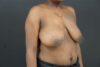 Breast Lift case #4682
