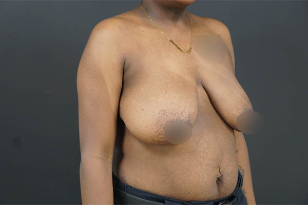 Breast Lift case #4682