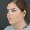 Chin Liposuction case #4829