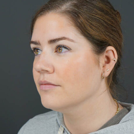 Chin Liposuction case #4829