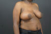 Breast Lift case #4682
