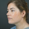Chin Liposuction case #4829