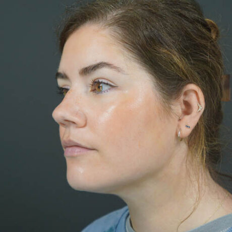 Chin Liposuction case #4829