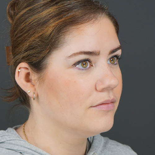 Chin Liposuction case #4829