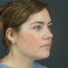 Chin Liposuction case #4829