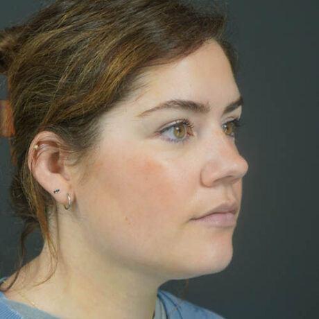 Chin Liposuction case #4829