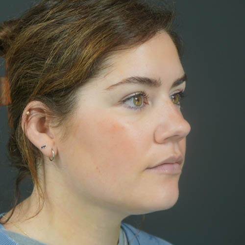 Chin Liposuction case #4829