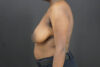 Breast Lift case #4682