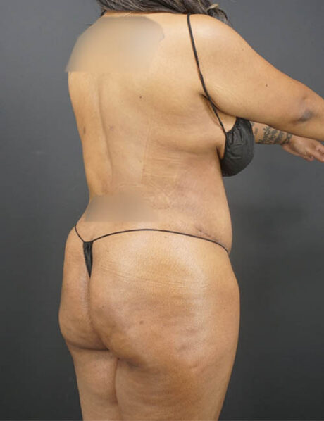 Liposuction case #4767
