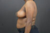 Breast Lift case #4682