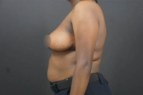 Breast Lift case #4682