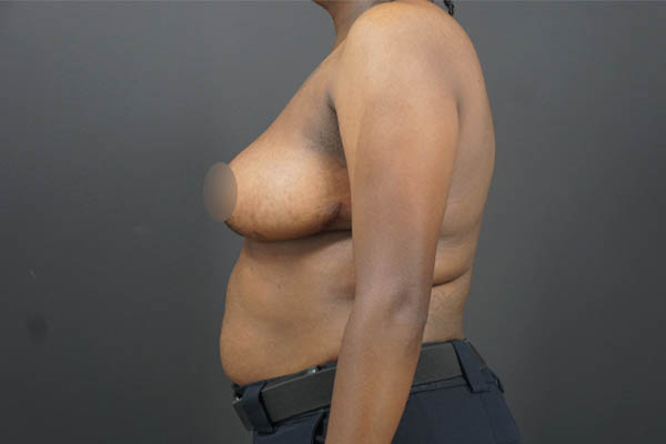 Breast Lift case #4682