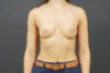 Breast Augmentation case #4694