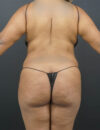 Liposuction case #4767