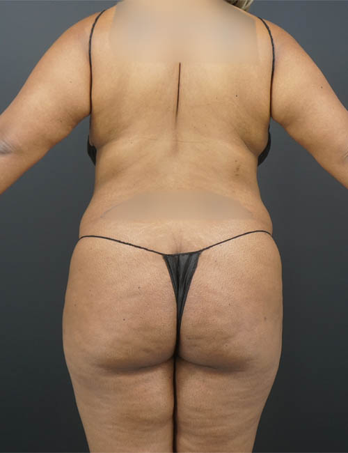 Liposuction case #4767