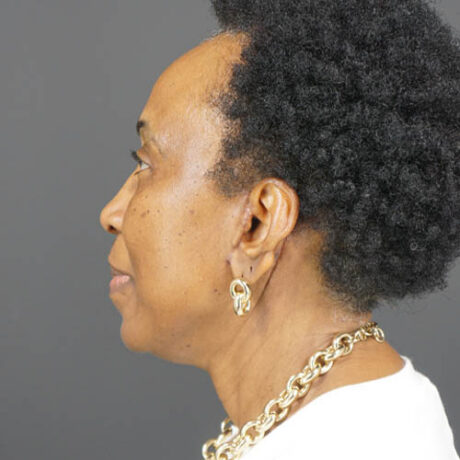 Facelift case #4841