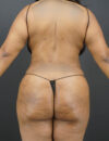 Liposuction case #4767