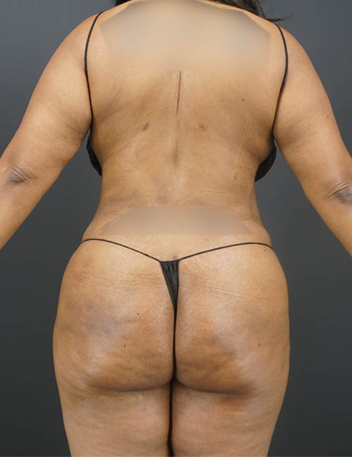 Liposuction case #4767
