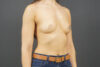 Breast Augmentation case #4694