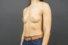 Breast Augmentation case #4694