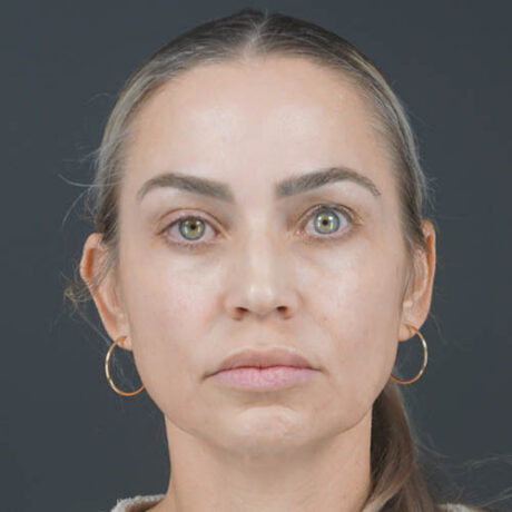 Facelift case #4855