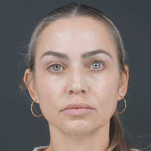 Facelift case #4855