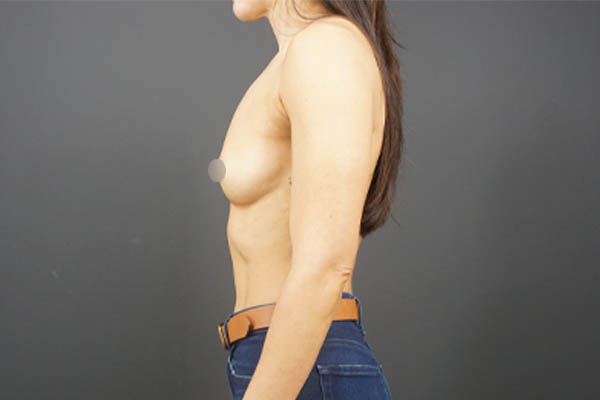 Breast Augmentation case #4694