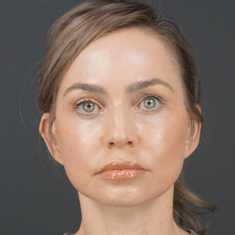 Facelift case #4855