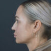 Facelift case #4855