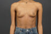 Breast Augmentation case #4708