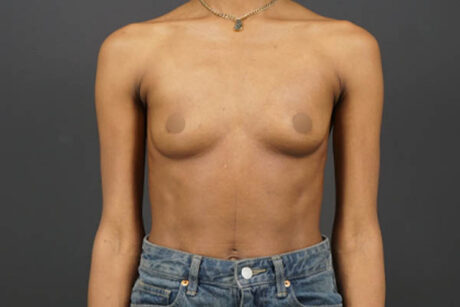 Breast Augmentation case #4708