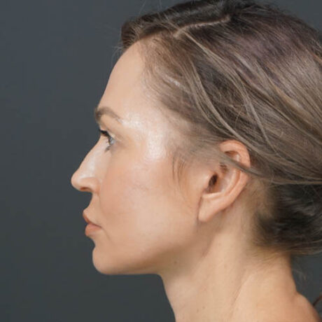 Facelift case #4855