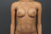 Breast Augmentation case #4708