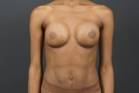 Breast Augmentation case #4708