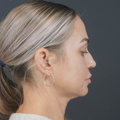 Facelift case #4855
