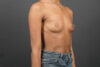 Breast Augmentation case #4708