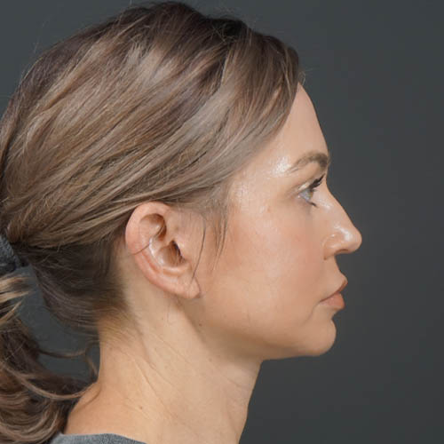 Facelift case #4855