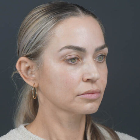 Facelift case #4855