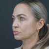 Facelift case #4855