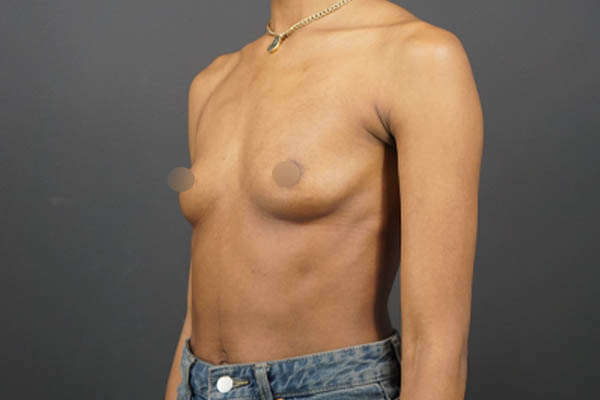 Breast Augmentation case #4708