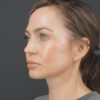 Facelift case #4855