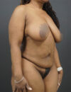 Tummy Tuck case #4815