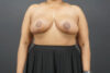 Breast Reduction case #4752