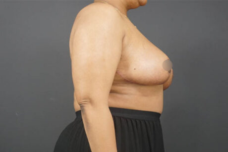 Breast Reduction case #4752