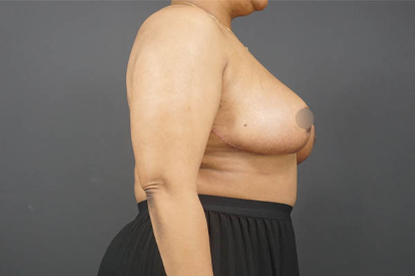 Breast Reduction case #4752