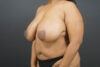 Breast Reduction case #4752